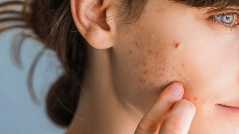 Woman with acne