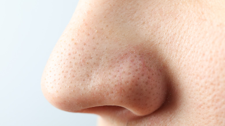Nose with blackheads