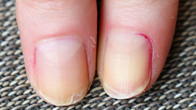 woman with brittle weak nails