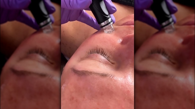 Hydrafacial treatment