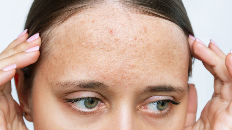 Forehead pimples