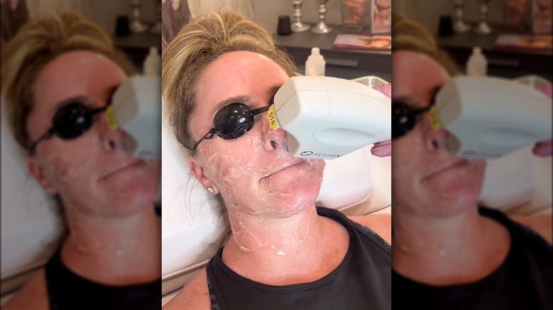 Woman getting an IPL Photo Facial