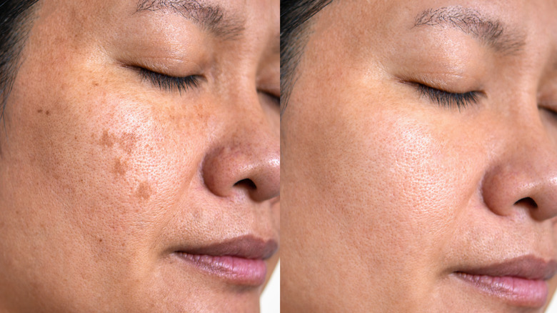 Treating melasma