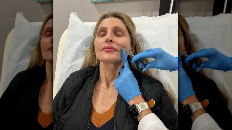 A woman getting RHA Dermal fillers