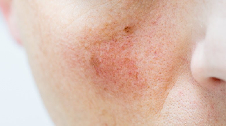 Rosacea