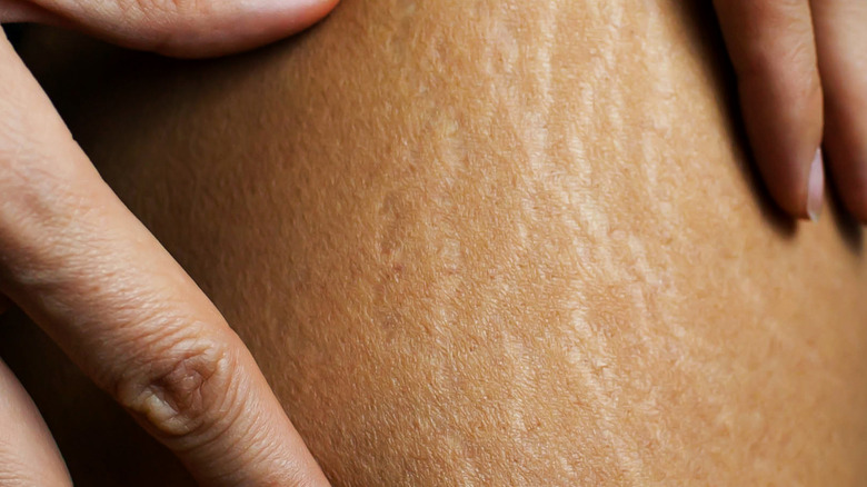 Stretch marks