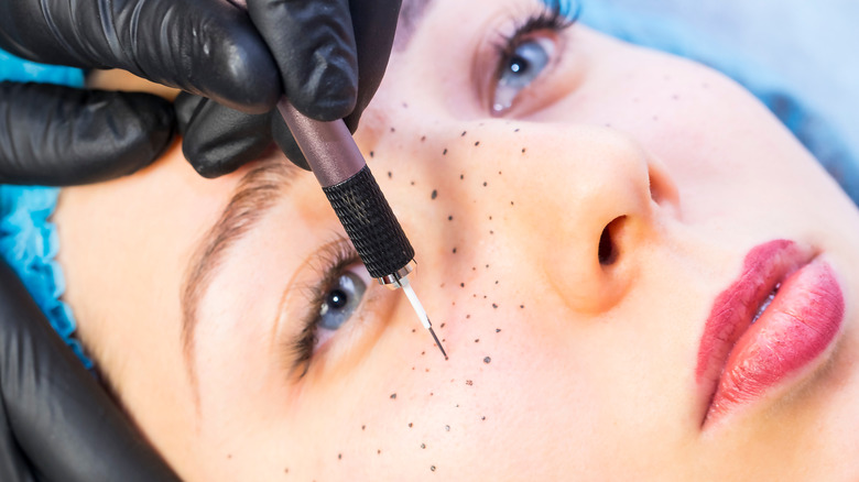 Getting freckle tattoos