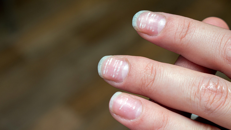 fingernails with white spots