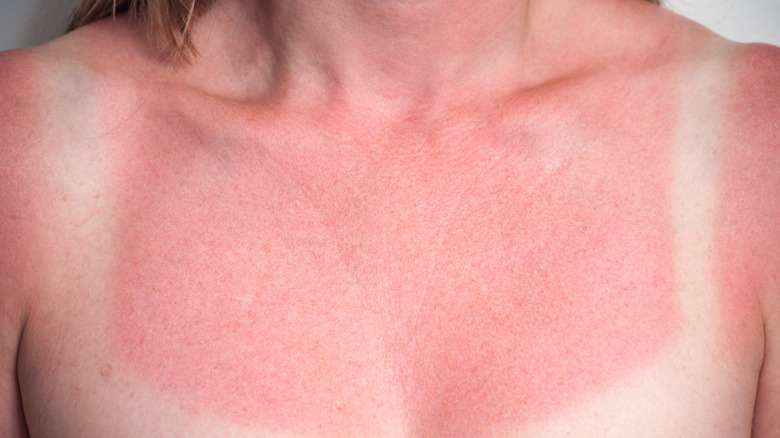 Sunburned decolletage 